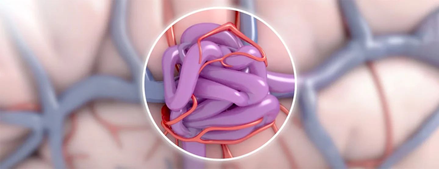 Aneurysm & AVM Surgery